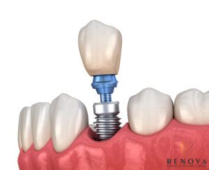 What Are Dental Implants 1122